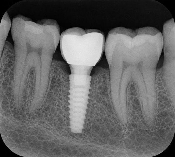 Radiografía digital de un implante dental con su corona