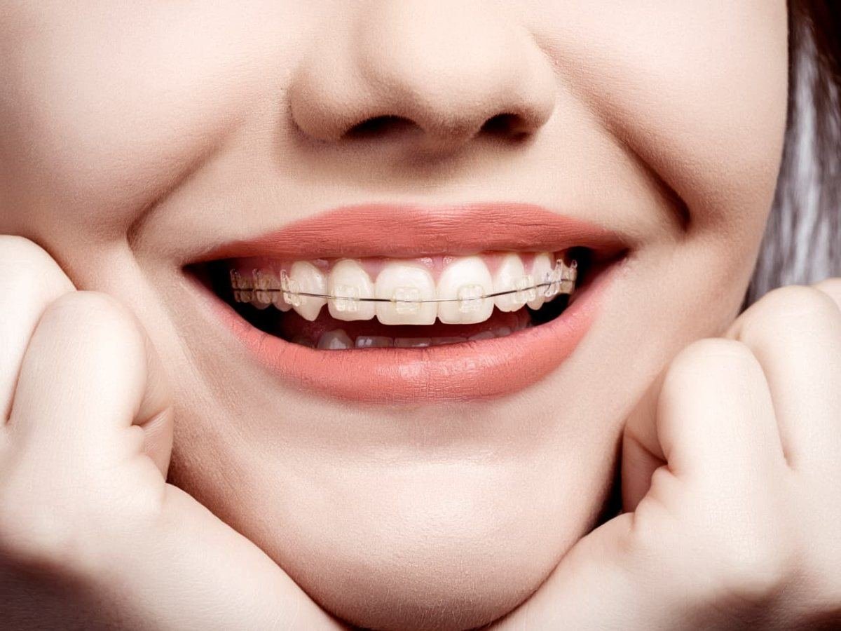 Sonrisa con brackets estéticos transparentes (imagen ilustrativa)